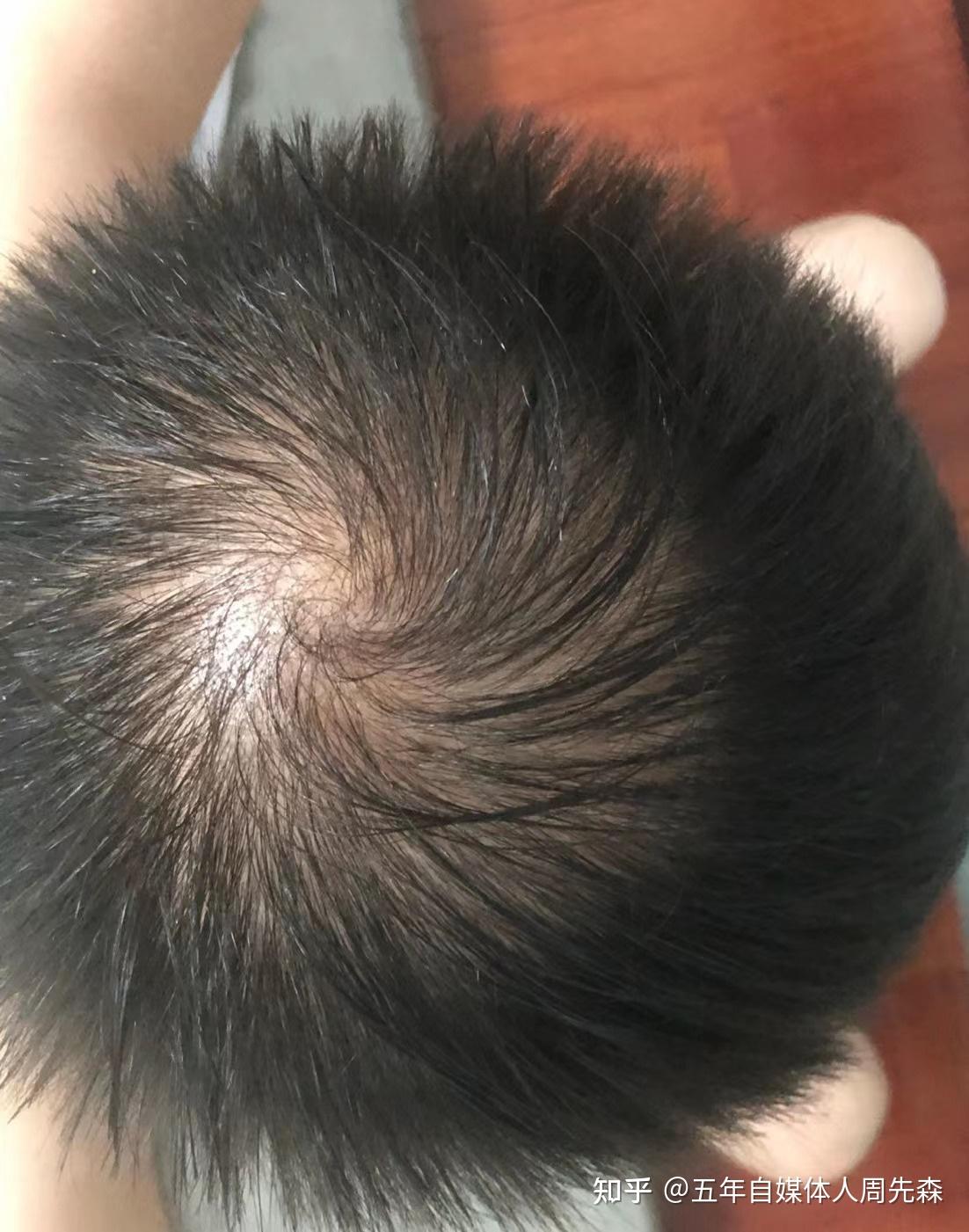 发旋处头发太少了!,我是不是要秃了,怎么办啊! - 知乎
