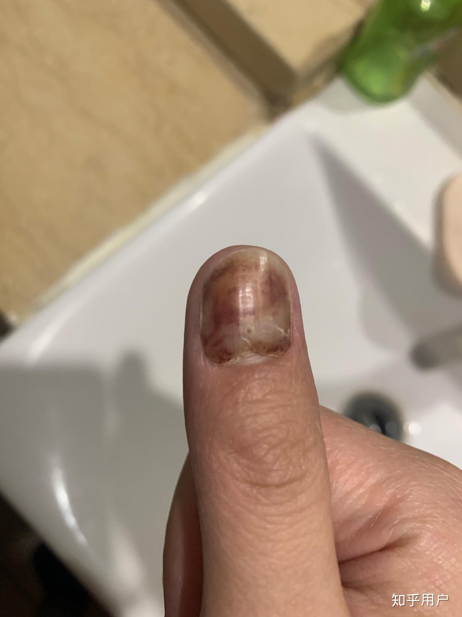 手指甲被夹到过了一段时间有黑色的淤血怎么处理