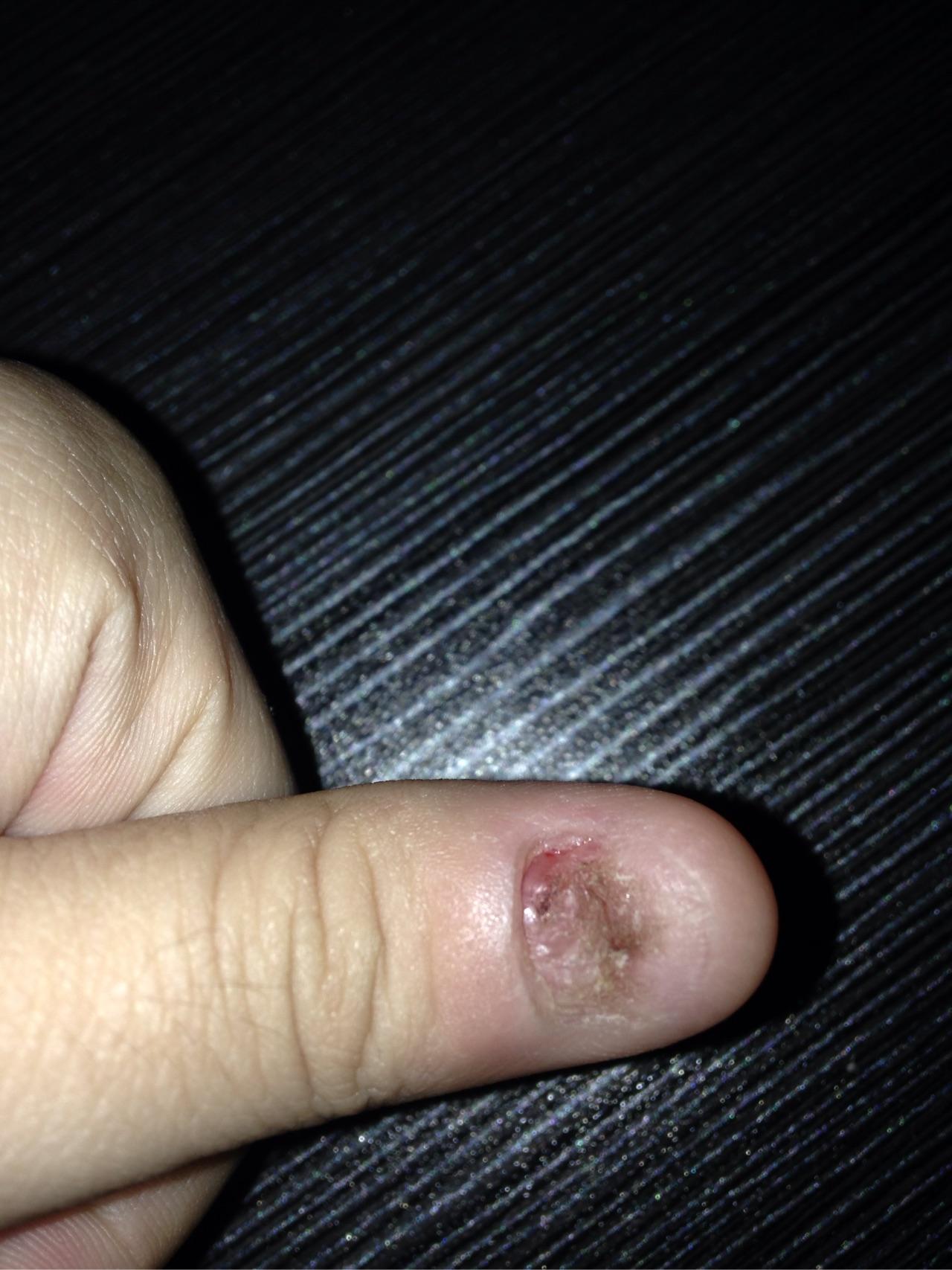 拔指甲是什么样的体验?很疼么? - 知乎