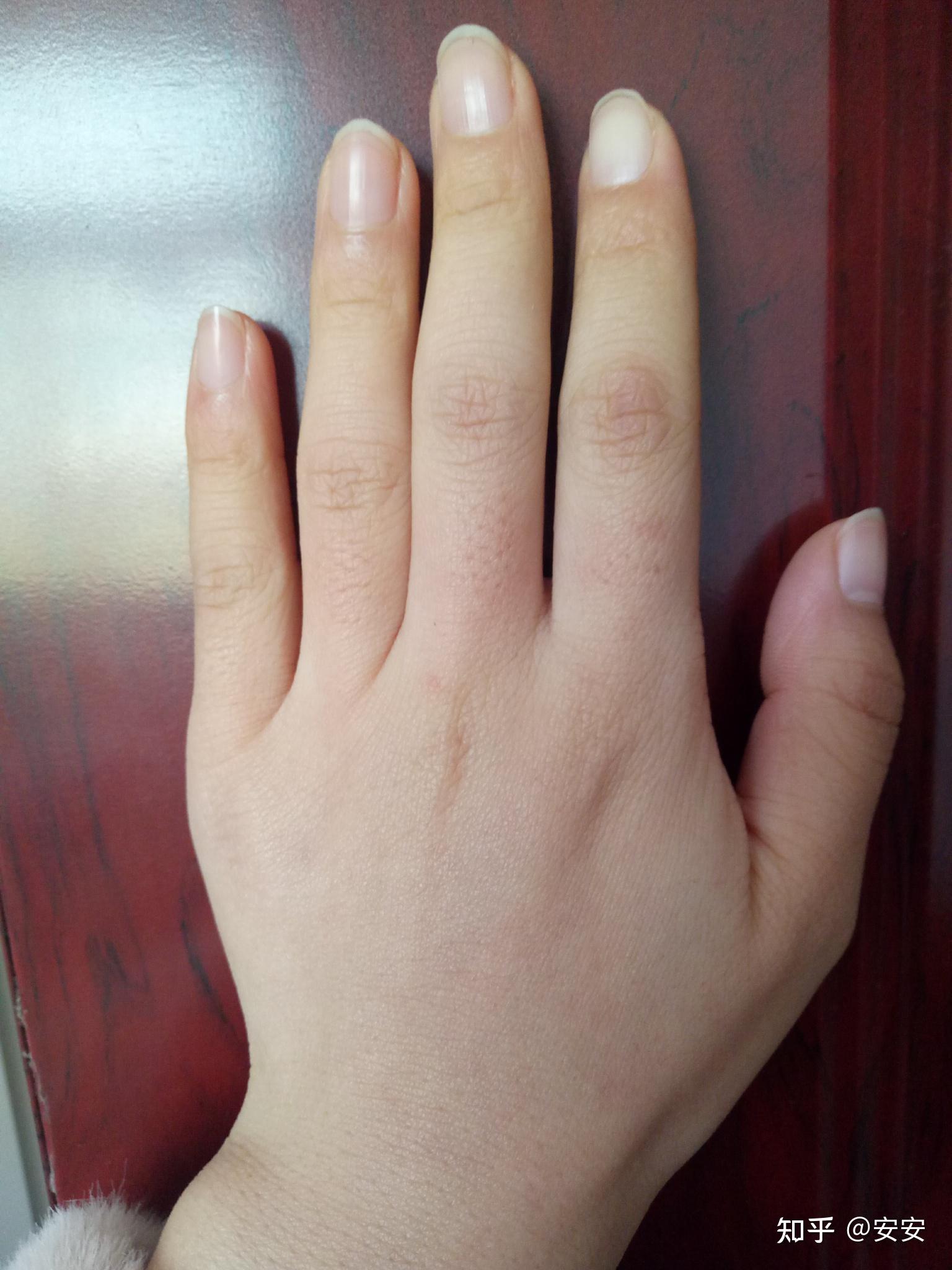 年纪轻轻23岁手上皮肤就很干有很多皱纹像老年人干瘪的手怎么办呀