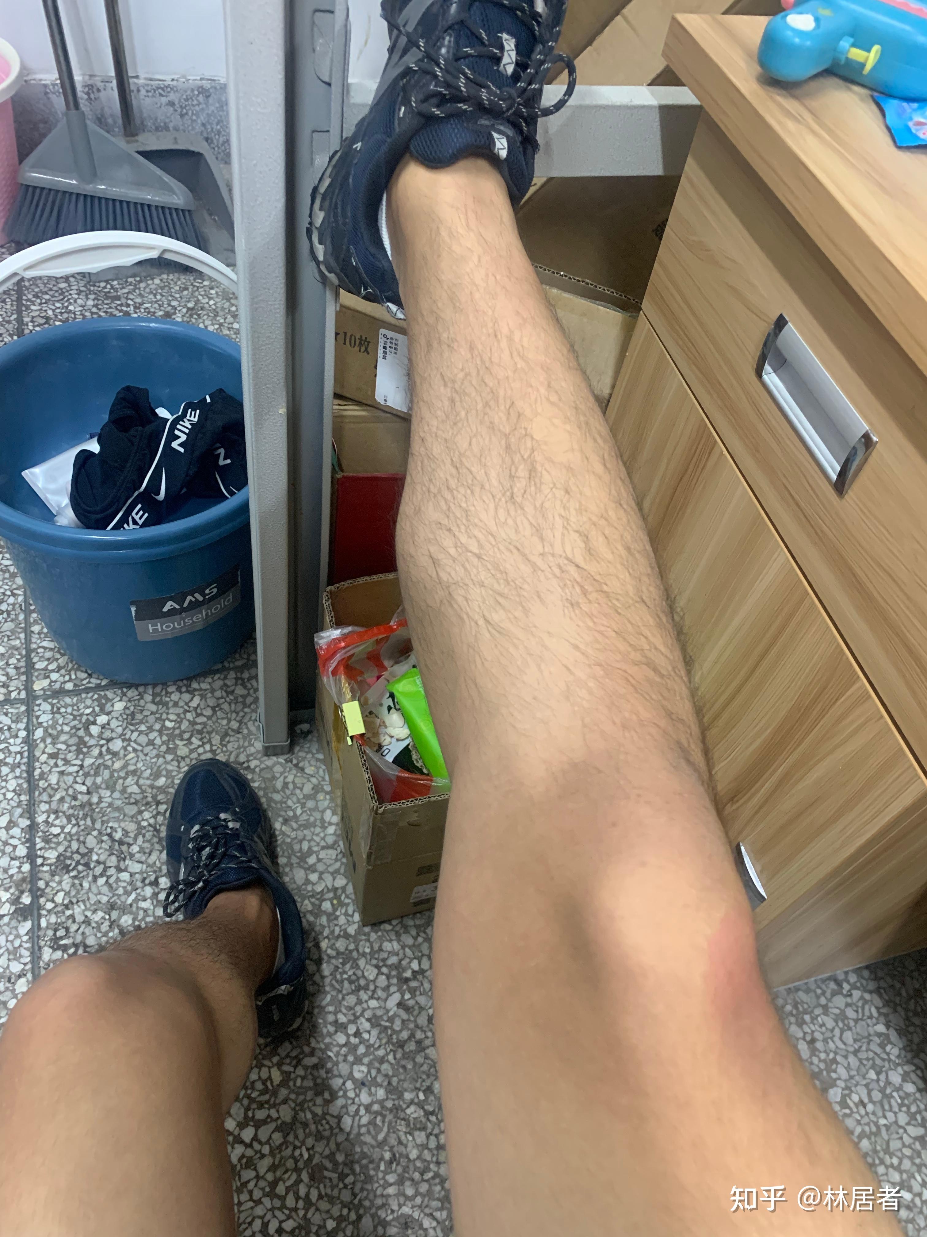 男生腿毛浓密怎么办