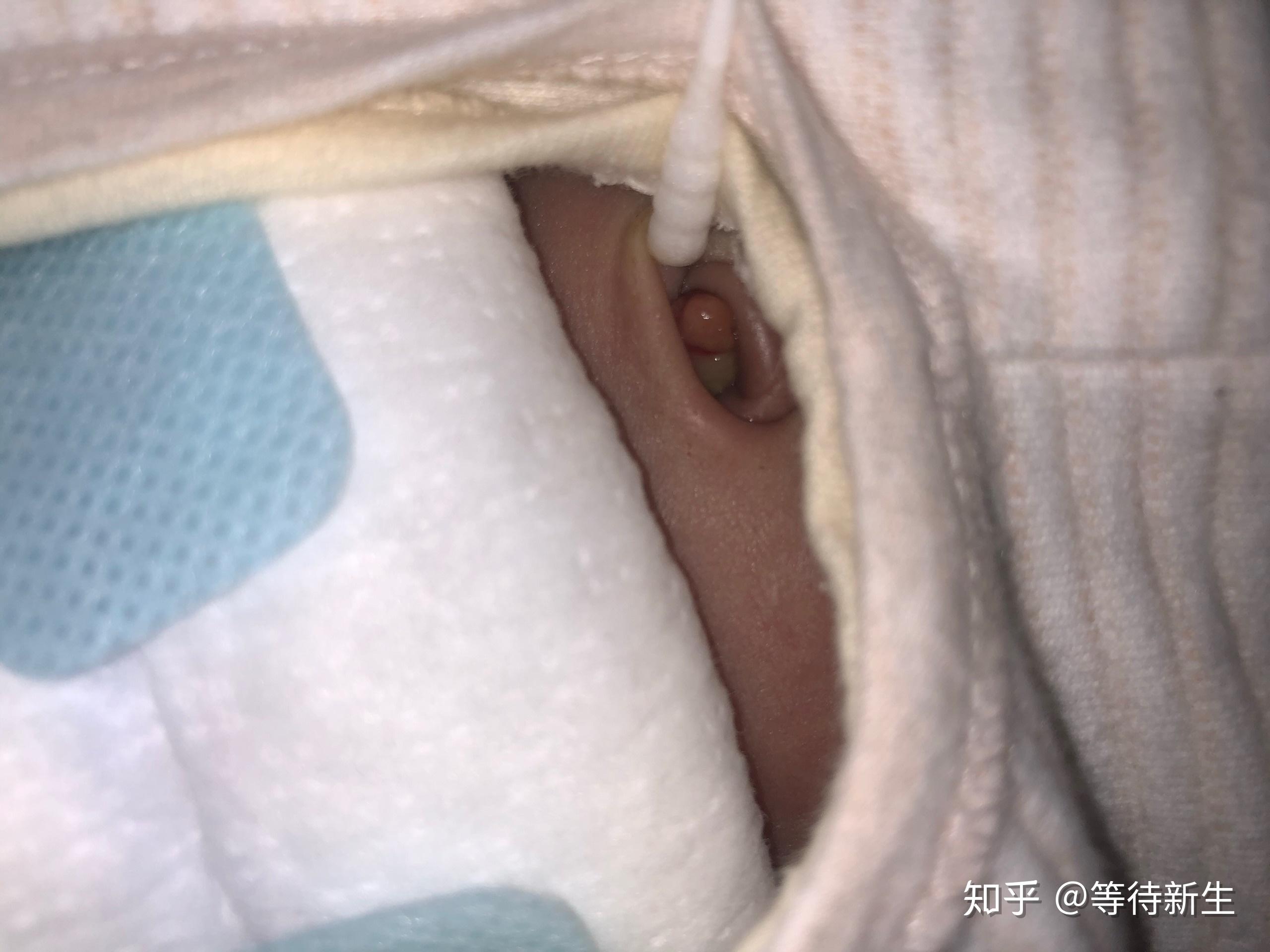 大神们请教一下听说盐敷法可以治疗宝宝脐茸国外医生都会建议家长采用