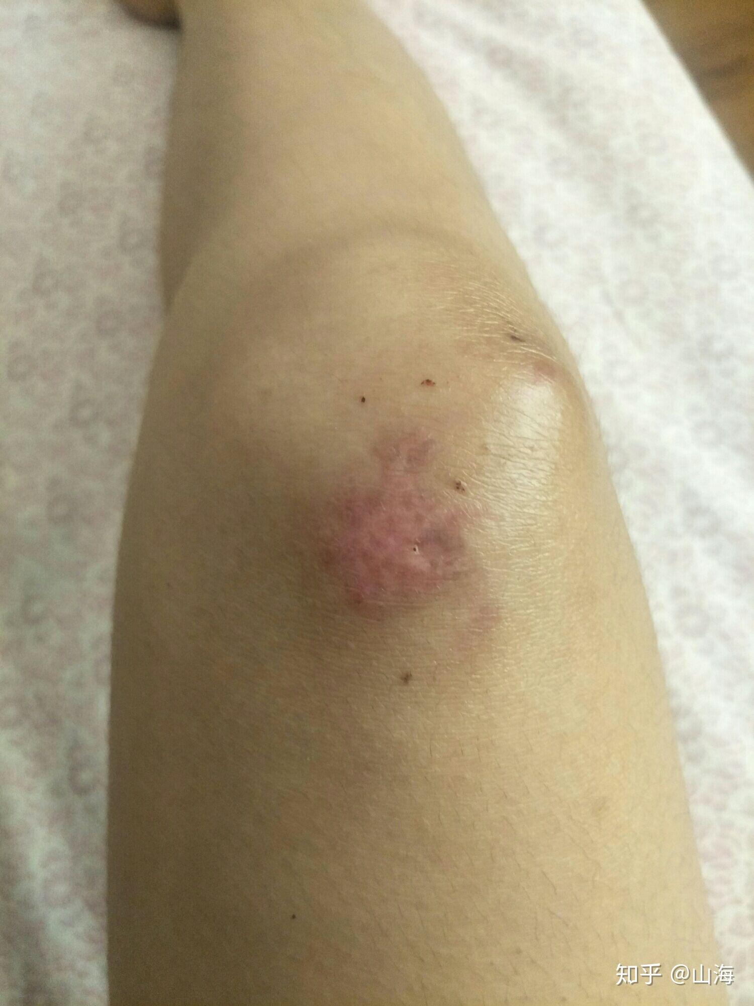 骑车侧翻膝盖摔伤破皮,怎么处理伤口,怎样才能不留疤? - 知乎