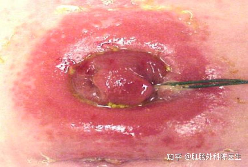 为什么说造口形态变化是造口渗漏的重要原因? - 知乎