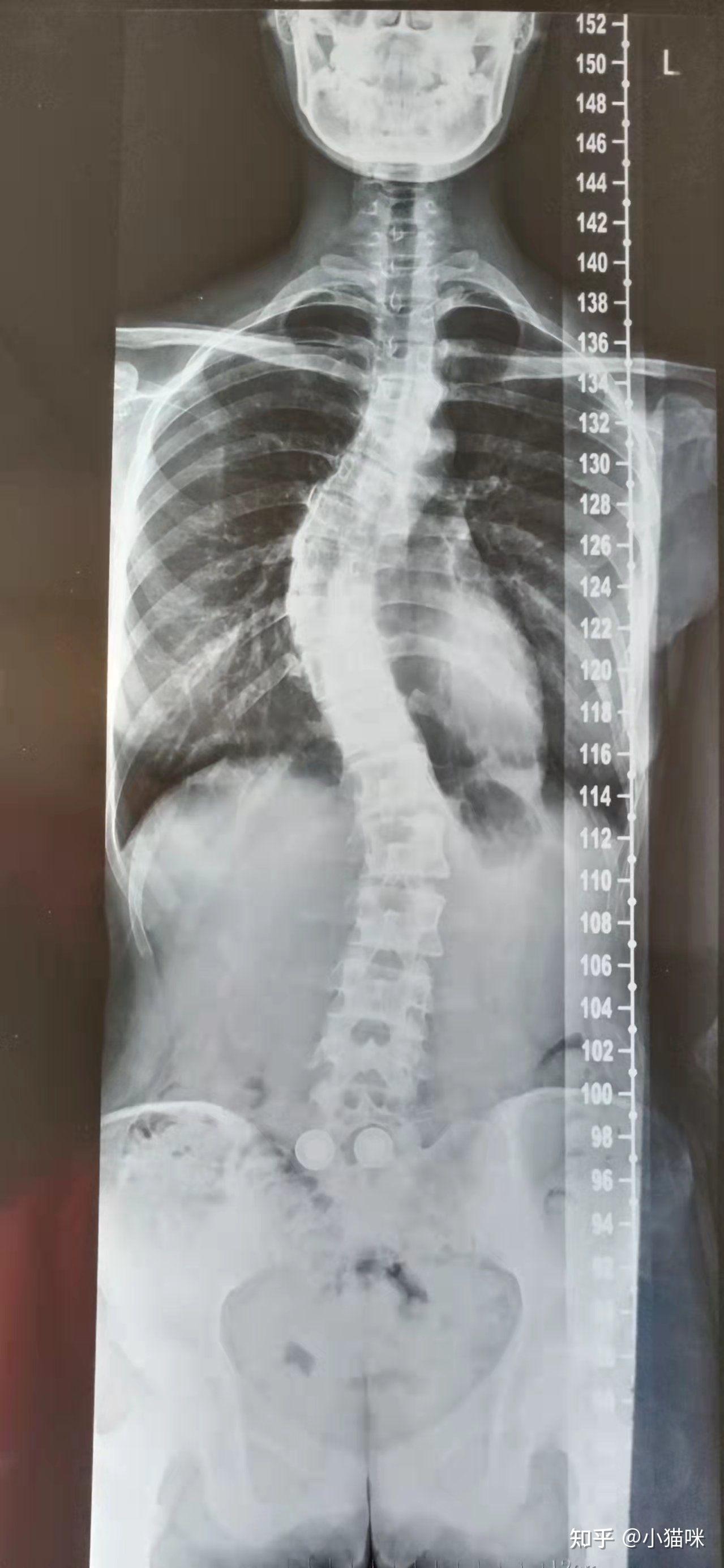 胸椎侧弯希望专业人士解答一下? - 知乎