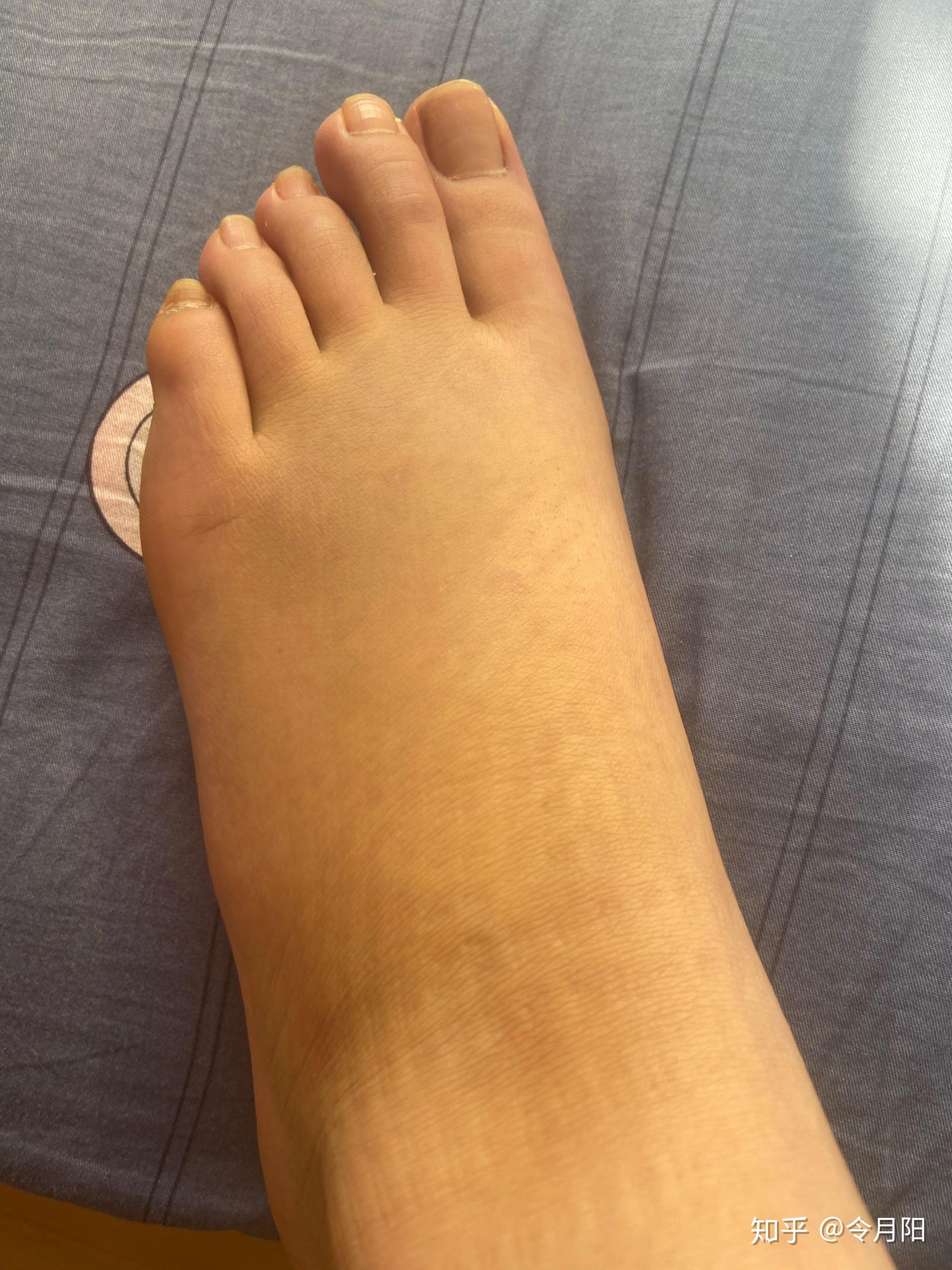 扭伤后脚背有肿块,请问怎么消肿? - 知乎