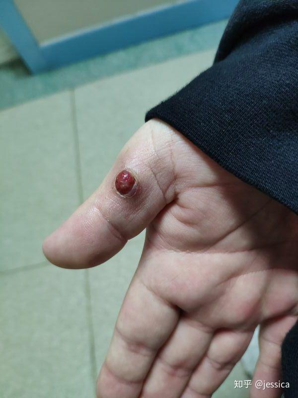 手指肚上长了一个红色小血泡是血管瘤还是什么呀