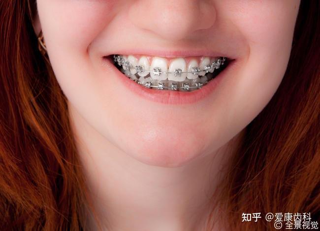 窟牙有什么坏处? - 知乎