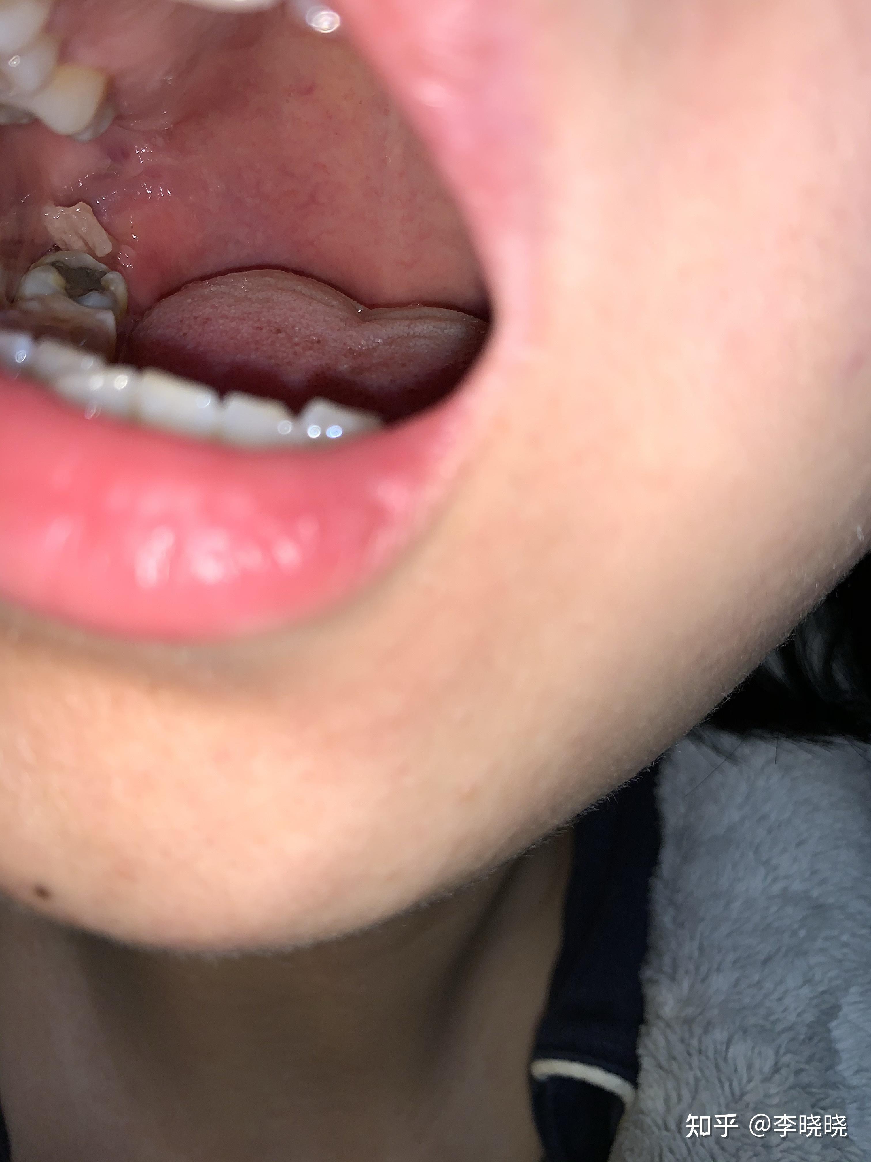 拔牙后血凝块长什么样子