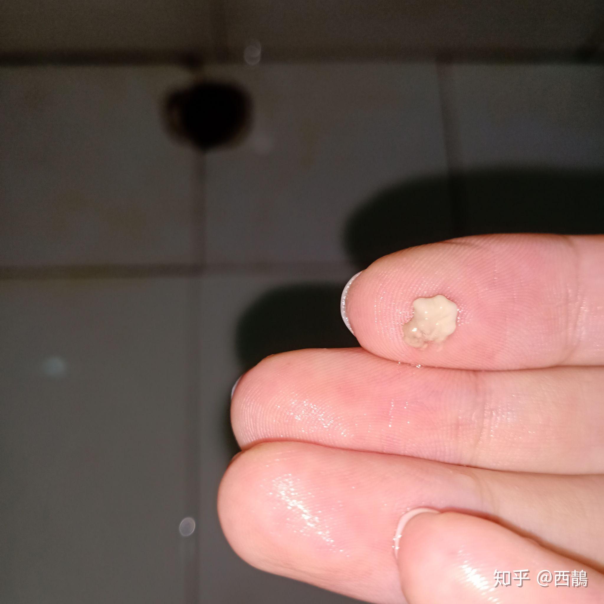 扁桃体结石如果不人为清除它自己会脱落吗