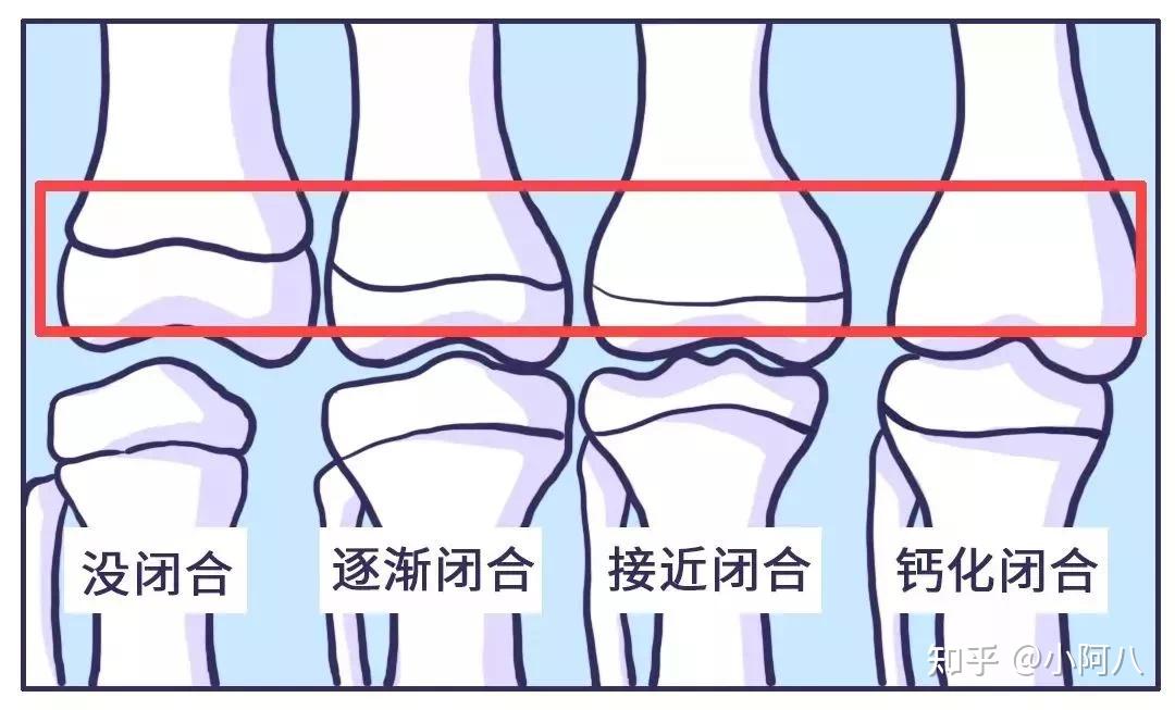 骨骺线开始闭合有哪些征兆？ - 知乎