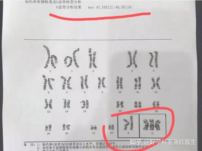 XXY染色体人的特征图片