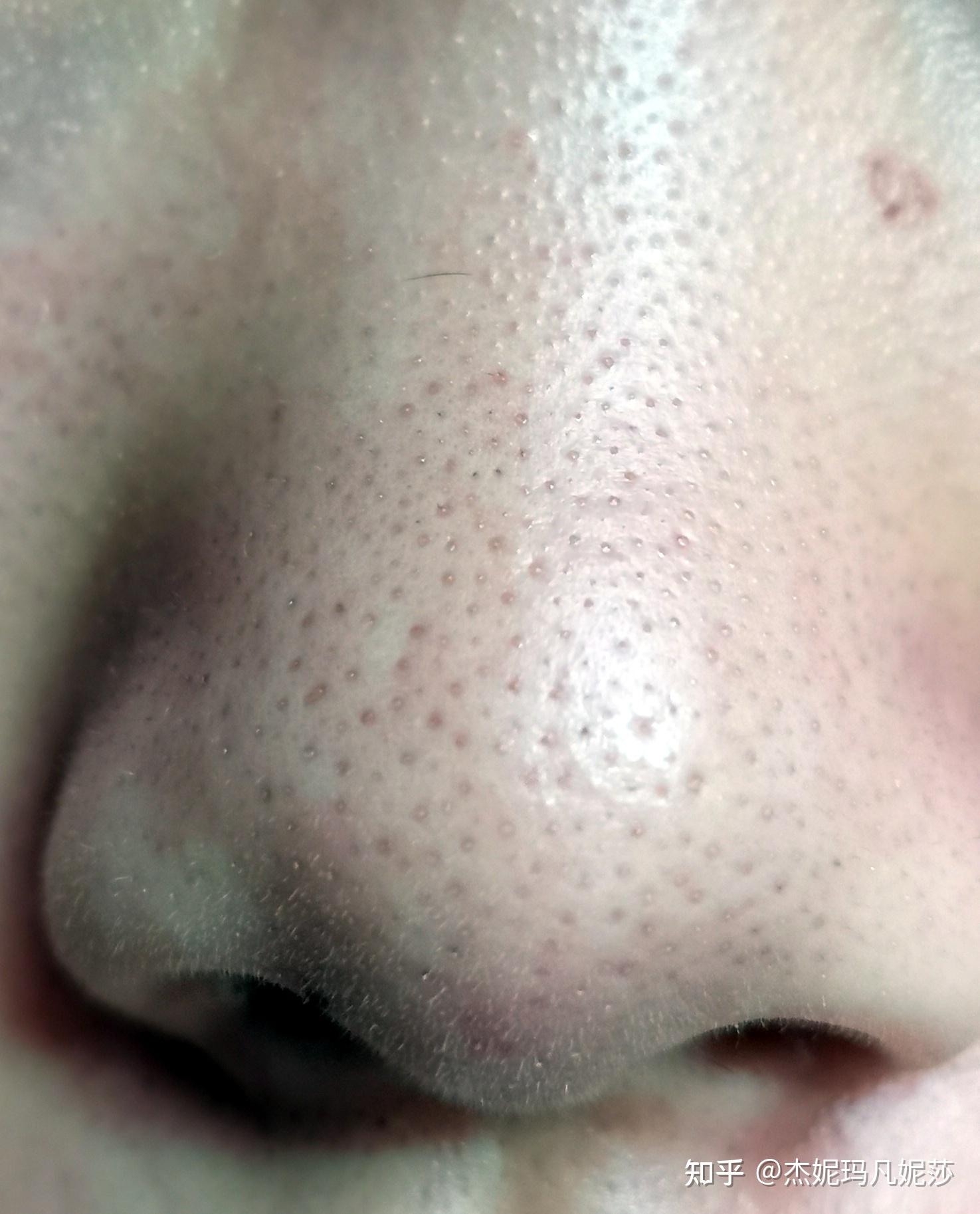 男生皮肤白皙但是夏天爱出油,而且鼻子上好多黑头,毛孔也有点粗大,怎