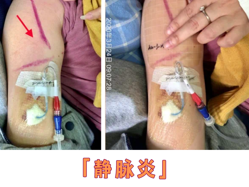 “管”助你健康的PICC,必学护理会了吗? - 知乎