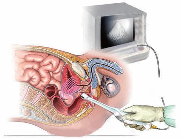指插直肠的方式是怎么检查前列腺的? - 知乎