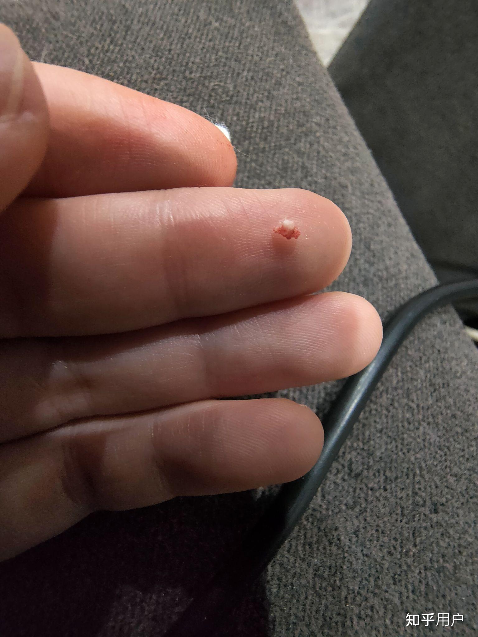 阻生智齿拔除快一个月了,原智齿牙窝侧面一直疼,感