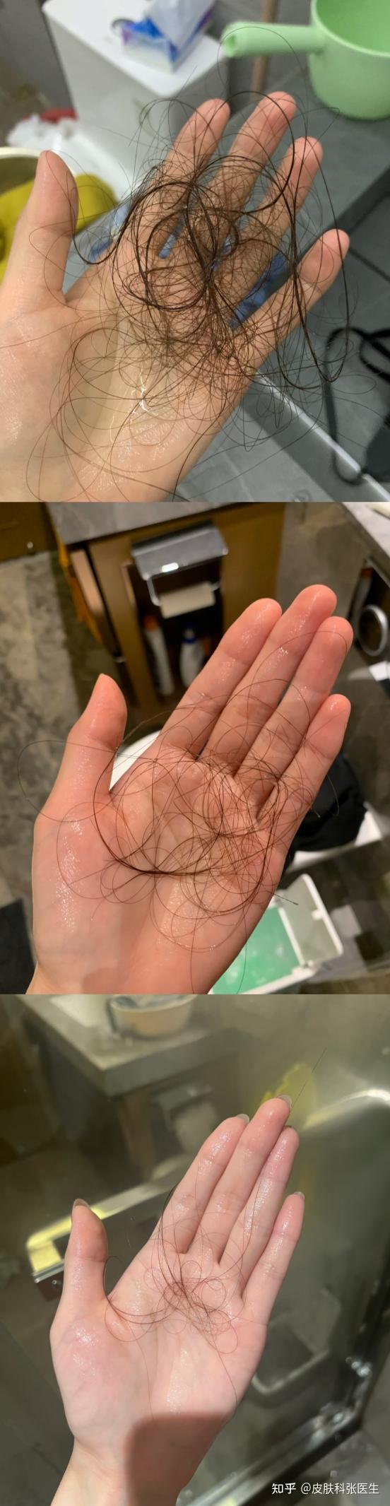 女生脱发很严重该如何解决?