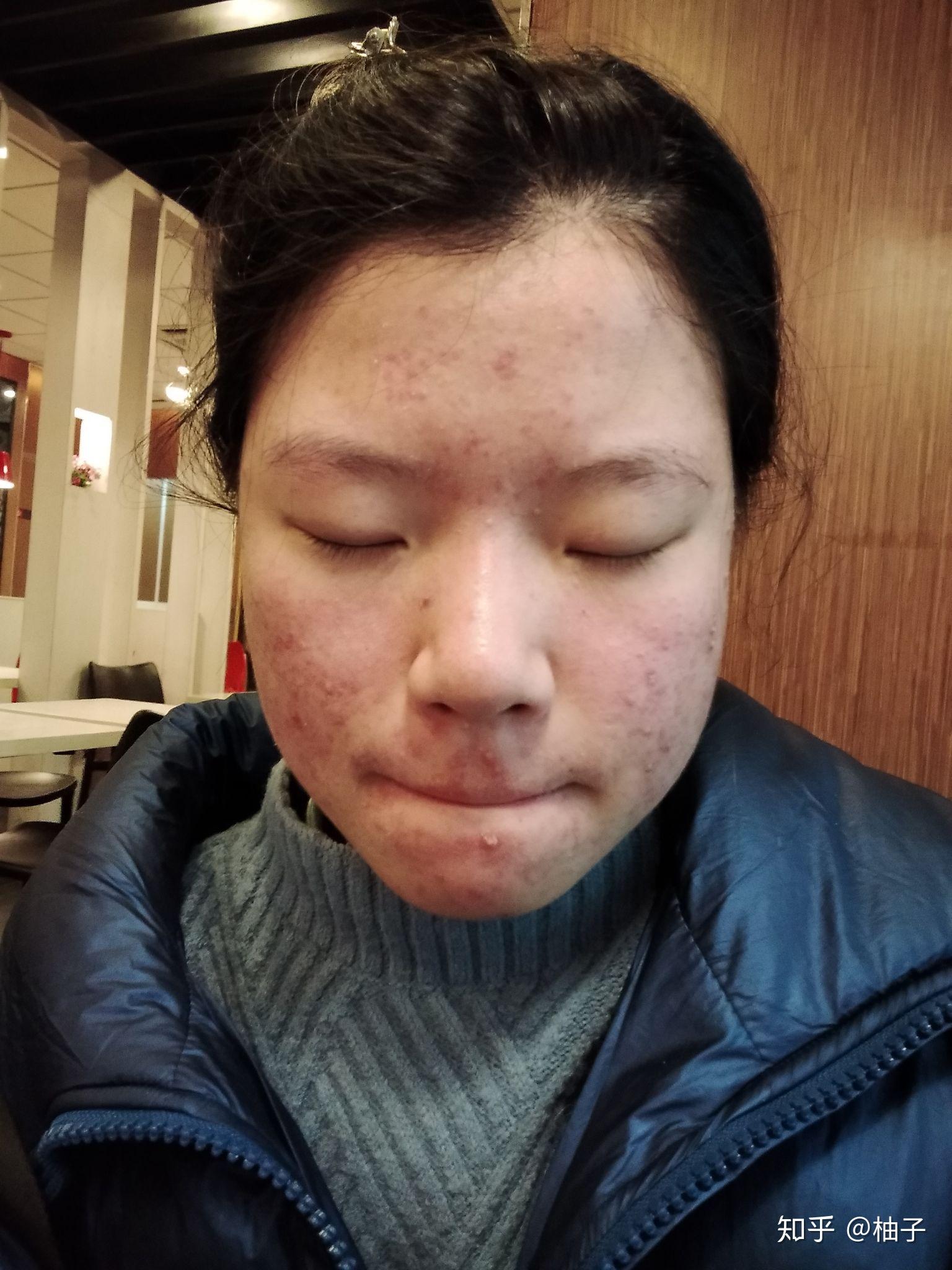 得重度痤疮是种怎样的体验? - 知乎