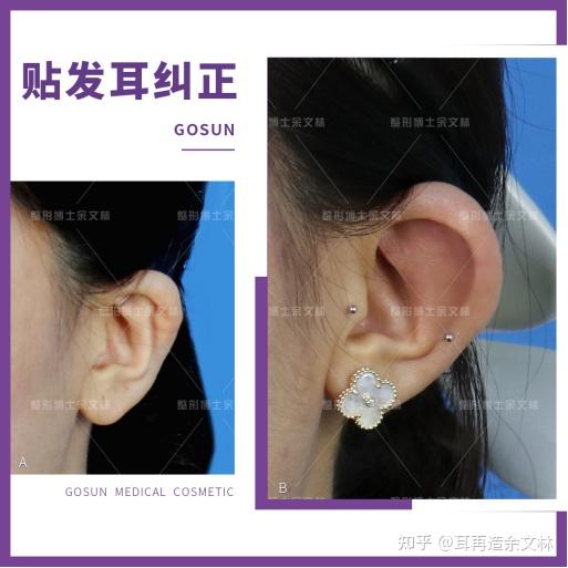耳朵太贴了怎么让耳朵立起来?贴发耳真实案例分享! - 知乎