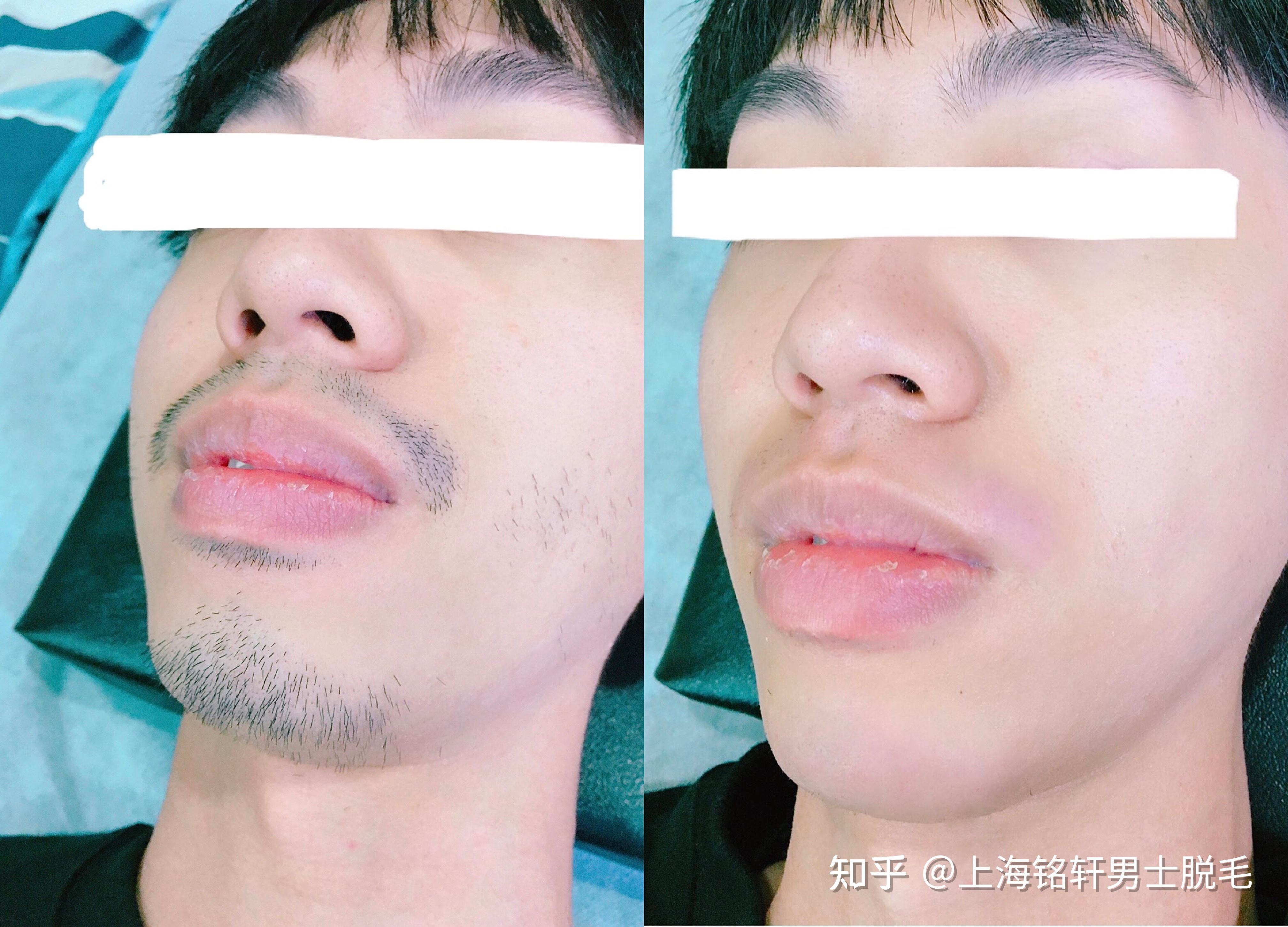 16岁胡子明显可以拔掉么