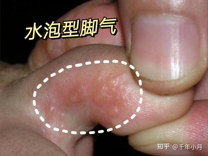 腳趾得水泡腳氣水泡應該弄破嗎