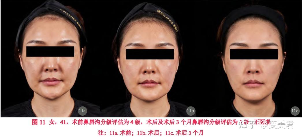 巨巨巨巨显老的法令纹/鼻唇沟怎么攻克？不要焦虑，照样可以淡化！真心希望所有有法令纹/鼻唇沟的姐妹都能刷到这篇！（内附改善动作） - 知乎