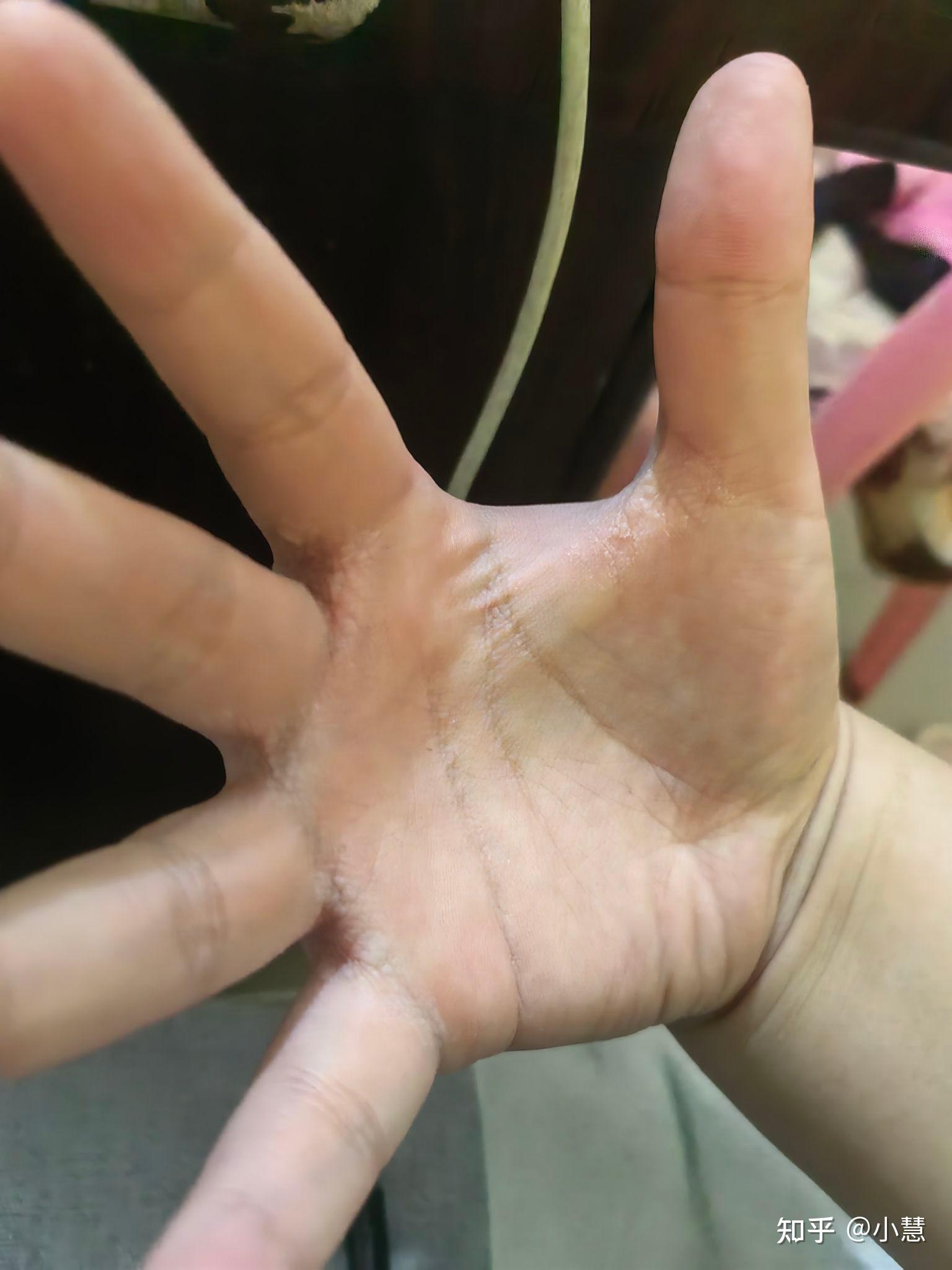 手指缝遇水起起皱脱皮?