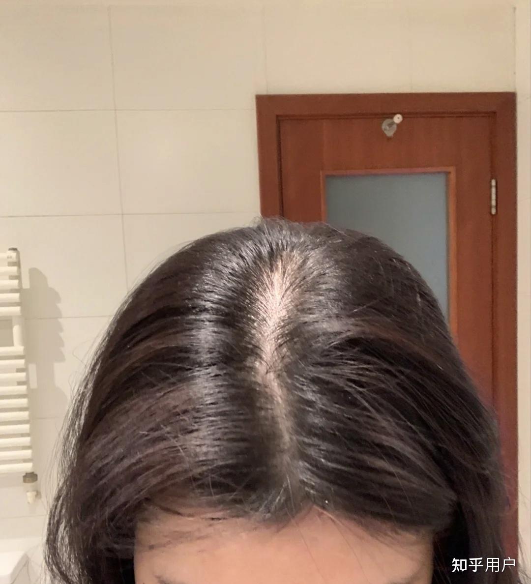 女性脂溢性脱发,有没有治愈的? - 知乎