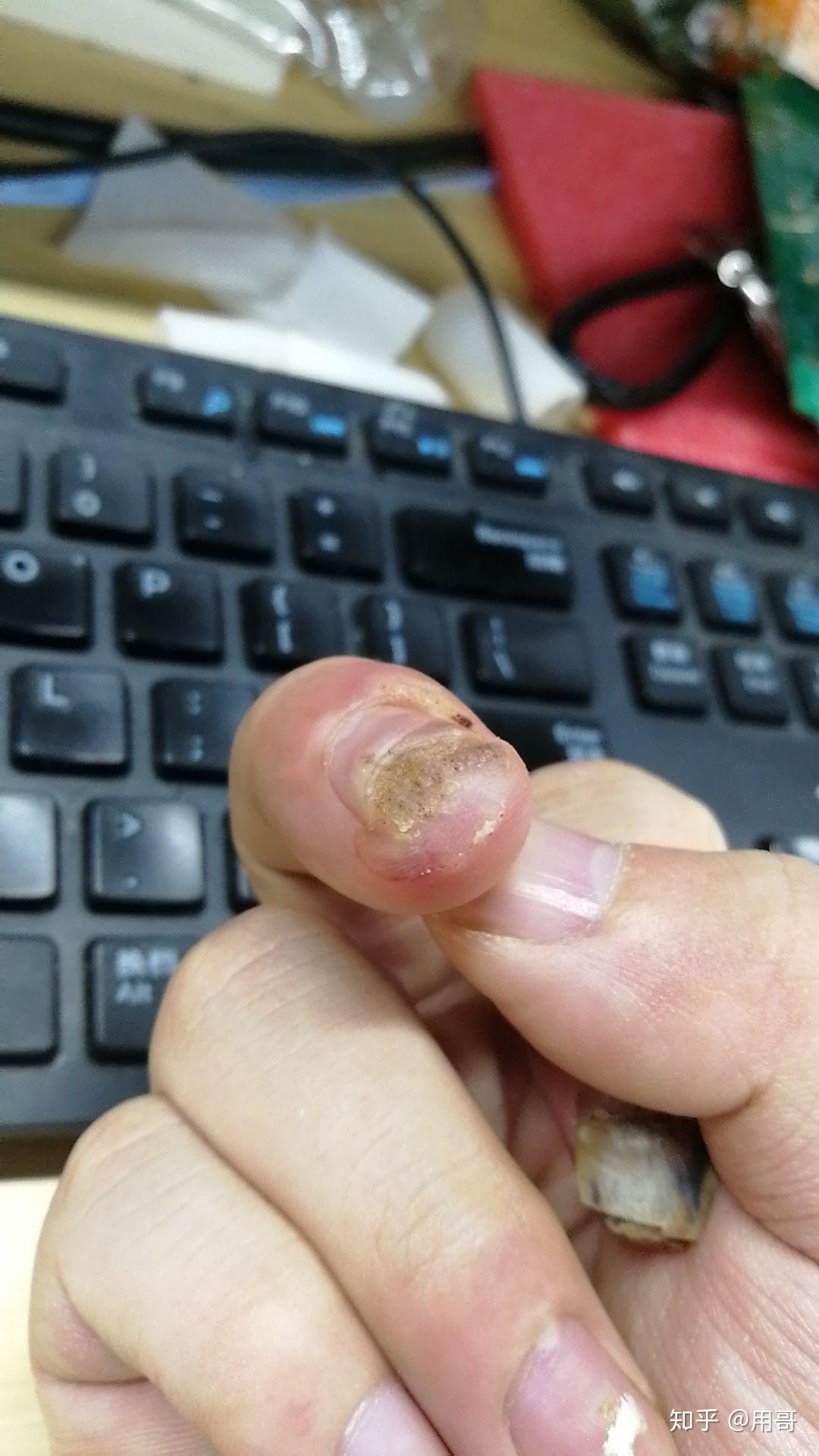 甲周疣最佳治疗方法是什么