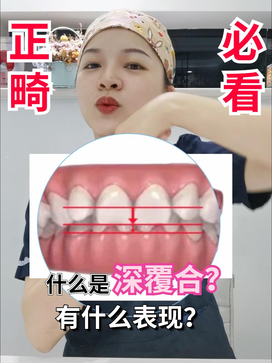 什么叫深覆合怎样判断自己是深覆合