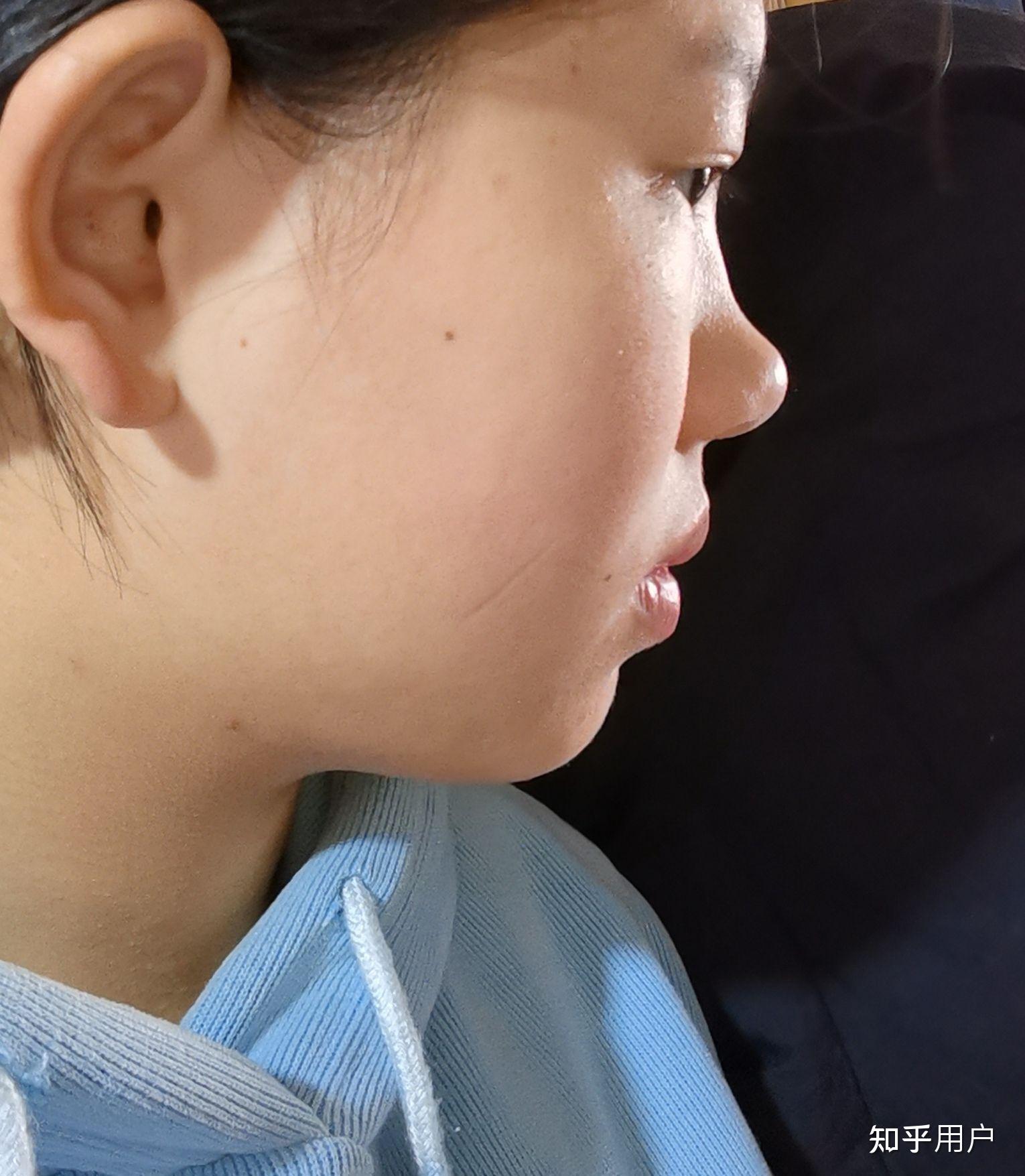 没有鼻梁鼻子塌的人是什么体验
