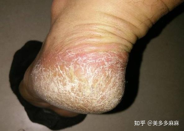 我长了脚气,很痒,有什么好办法先让他不痒?