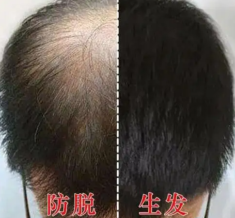 生发液哪款好?别再胡乱选择生发精华，附6款亲身体验的生发液推荐! - 知乎