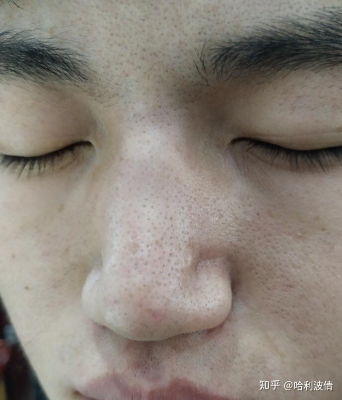 后背上有这样的黑头,是什么原因,应该怎么治疗? - 知乎
