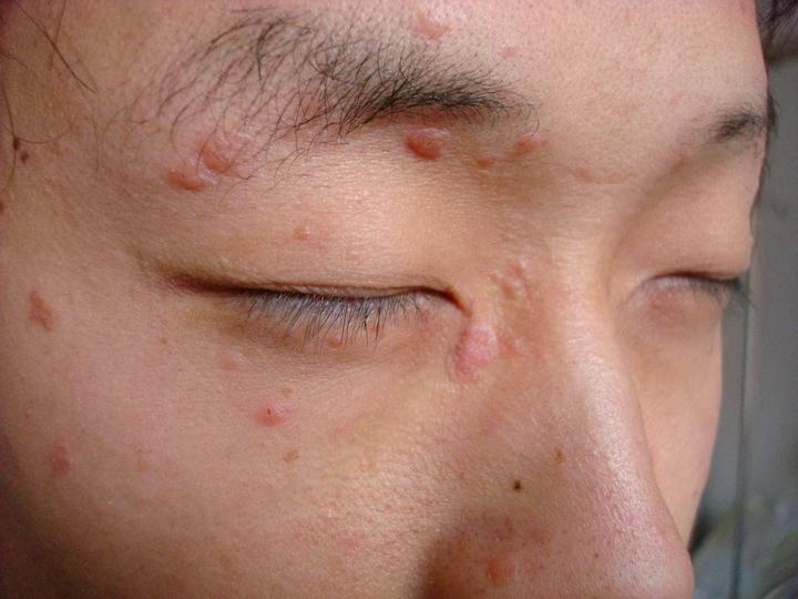 扁平疣如何自愈?扁平疣自愈前的征兆有哪些? - 知乎