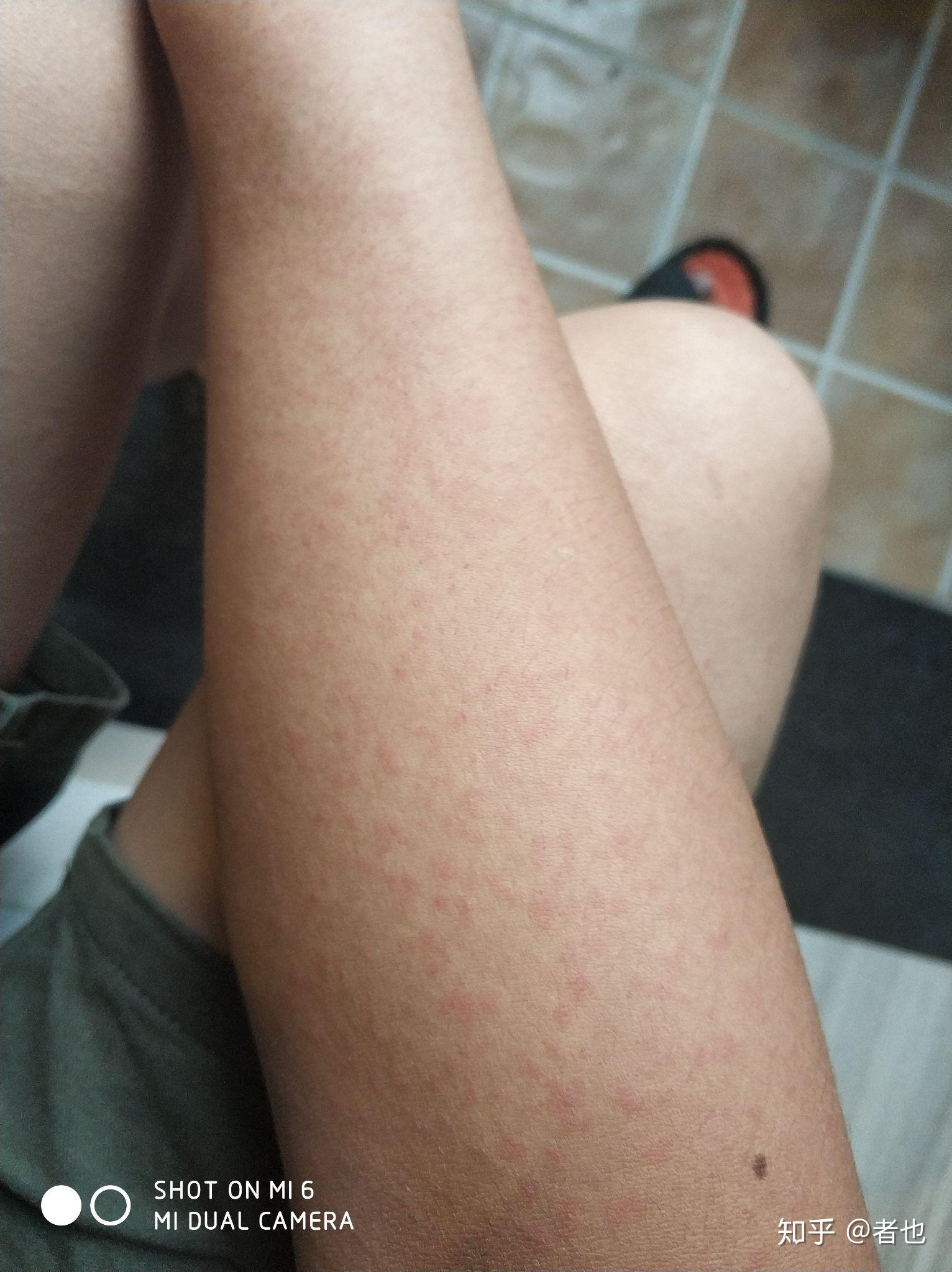 病毒疹病状是什么样什么样子才算是痊愈