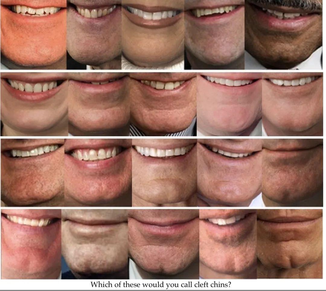 有欧米伽ω下巴,也就是所说的美人沟下巴是一种怎样的体验? - 知乎