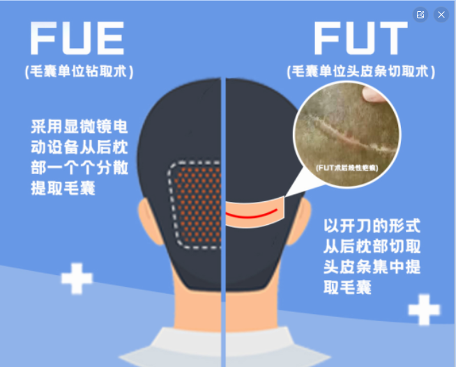 【脱发科普】 植发技术有哪些？ - 知乎