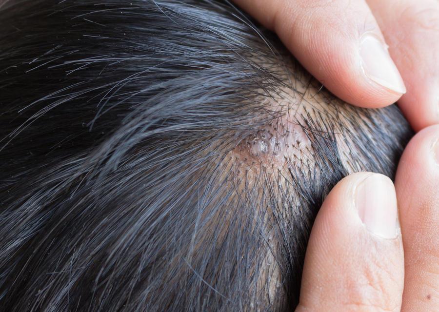 脱发是毛囊炎引起的吗? - 知乎