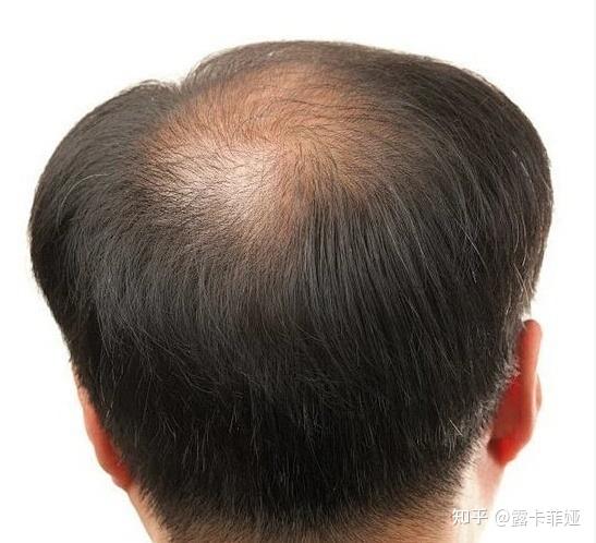 怎样拯救秃头青年