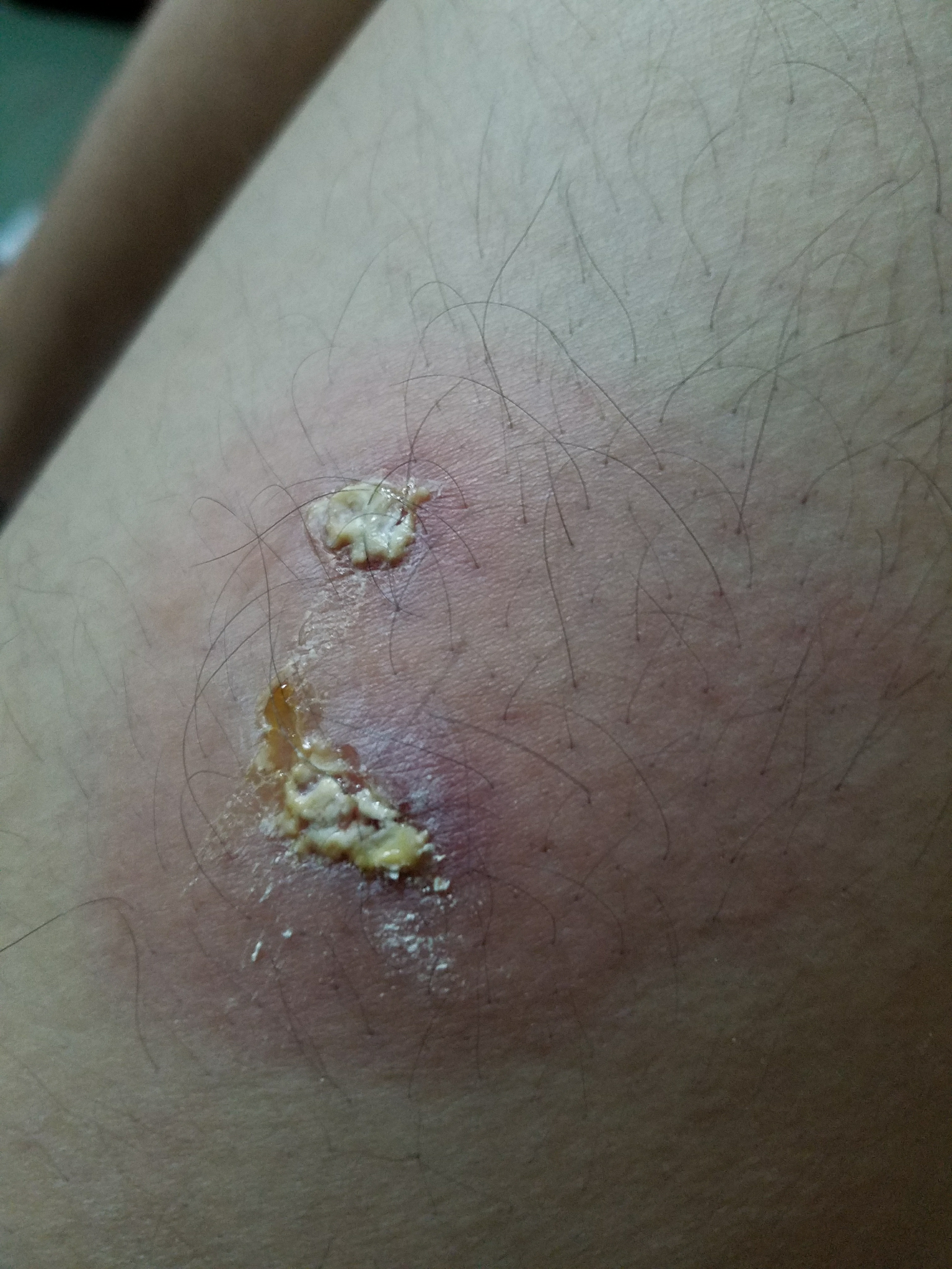 芒果蝇和皮蝇有什么区别