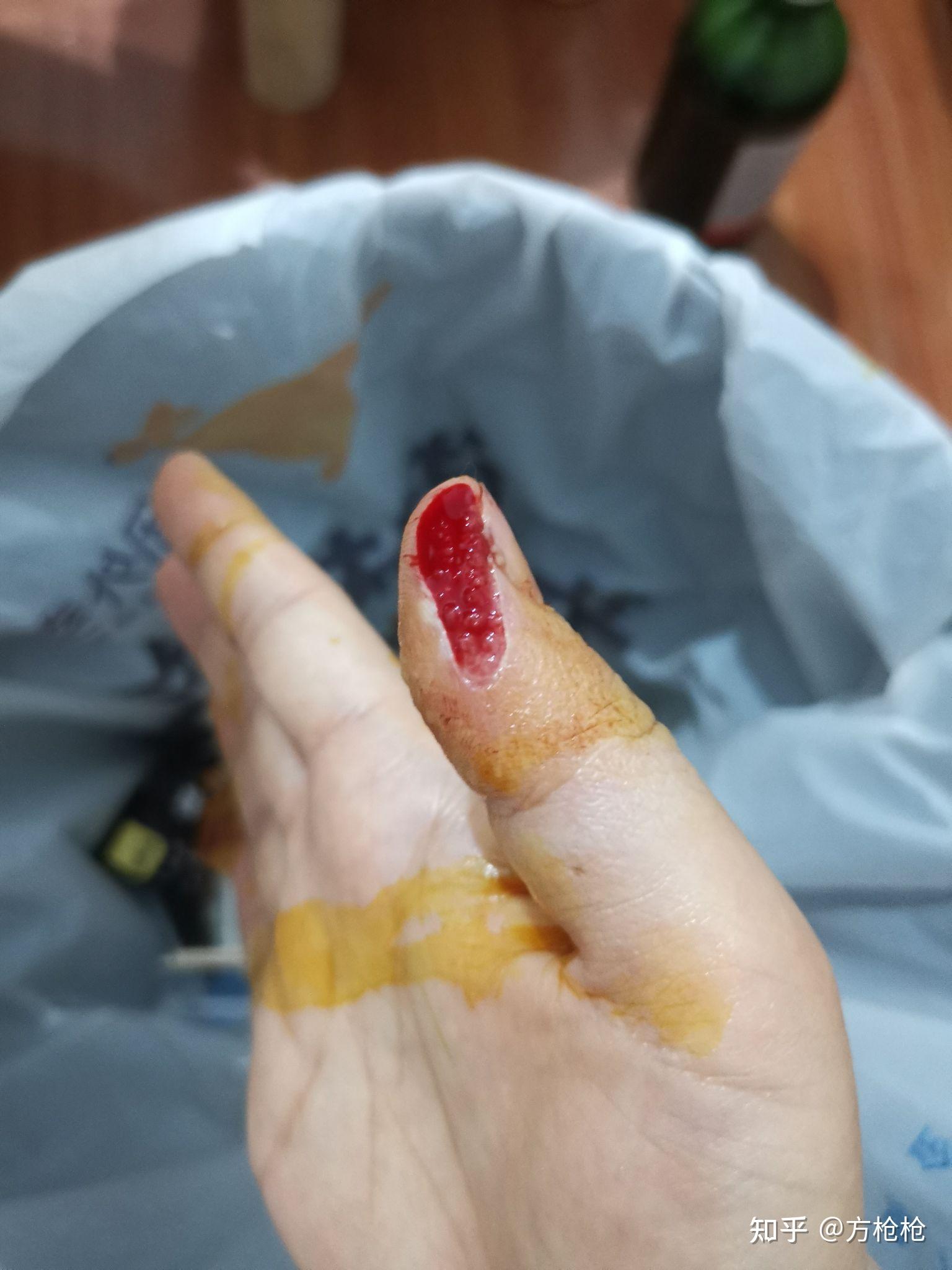 手指被切下一块肉,多长时间能恢复? - 知乎