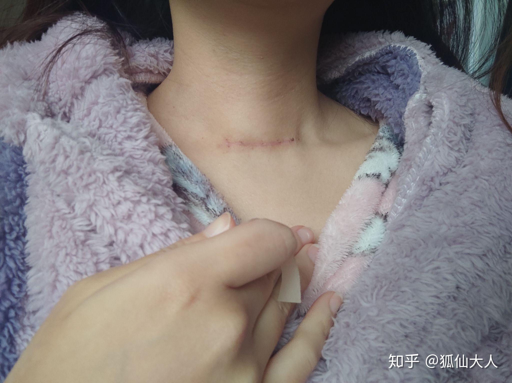 甲状腺术后疤痕增生,用什么祛疤膏好一些? - 知乎