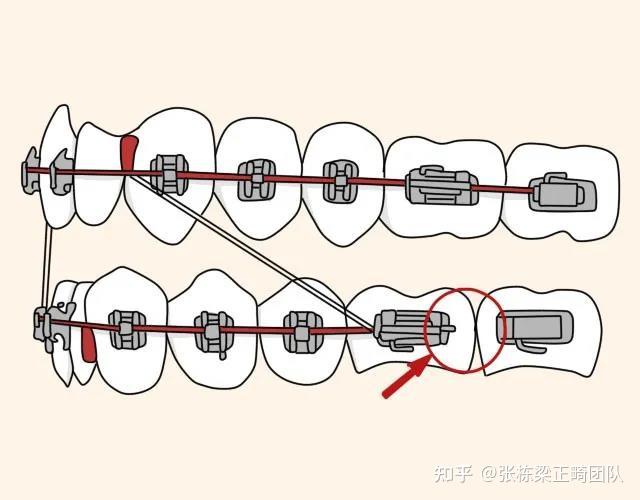 正畸这种挂皮筋有什么作用