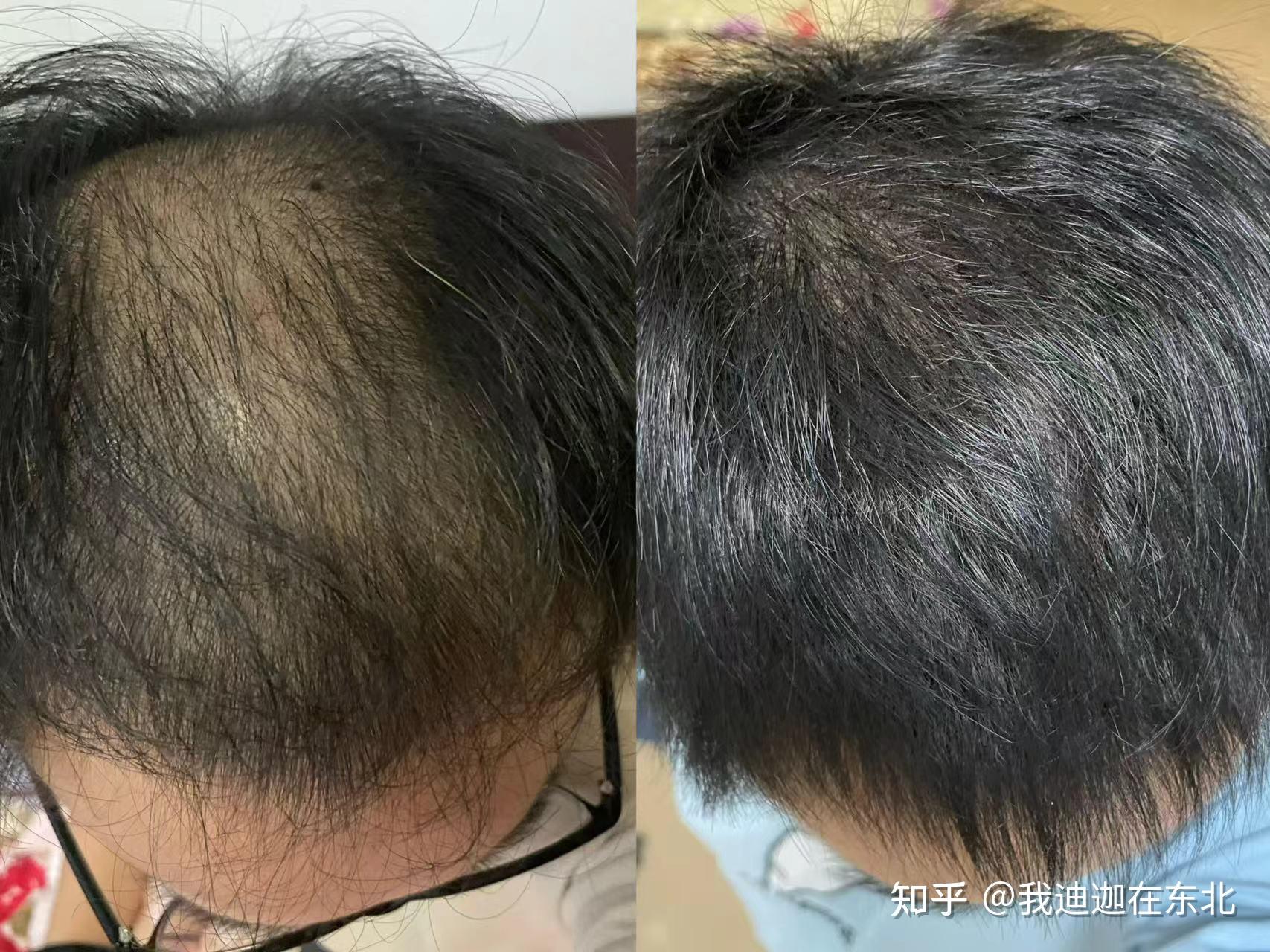 头发少为什么
