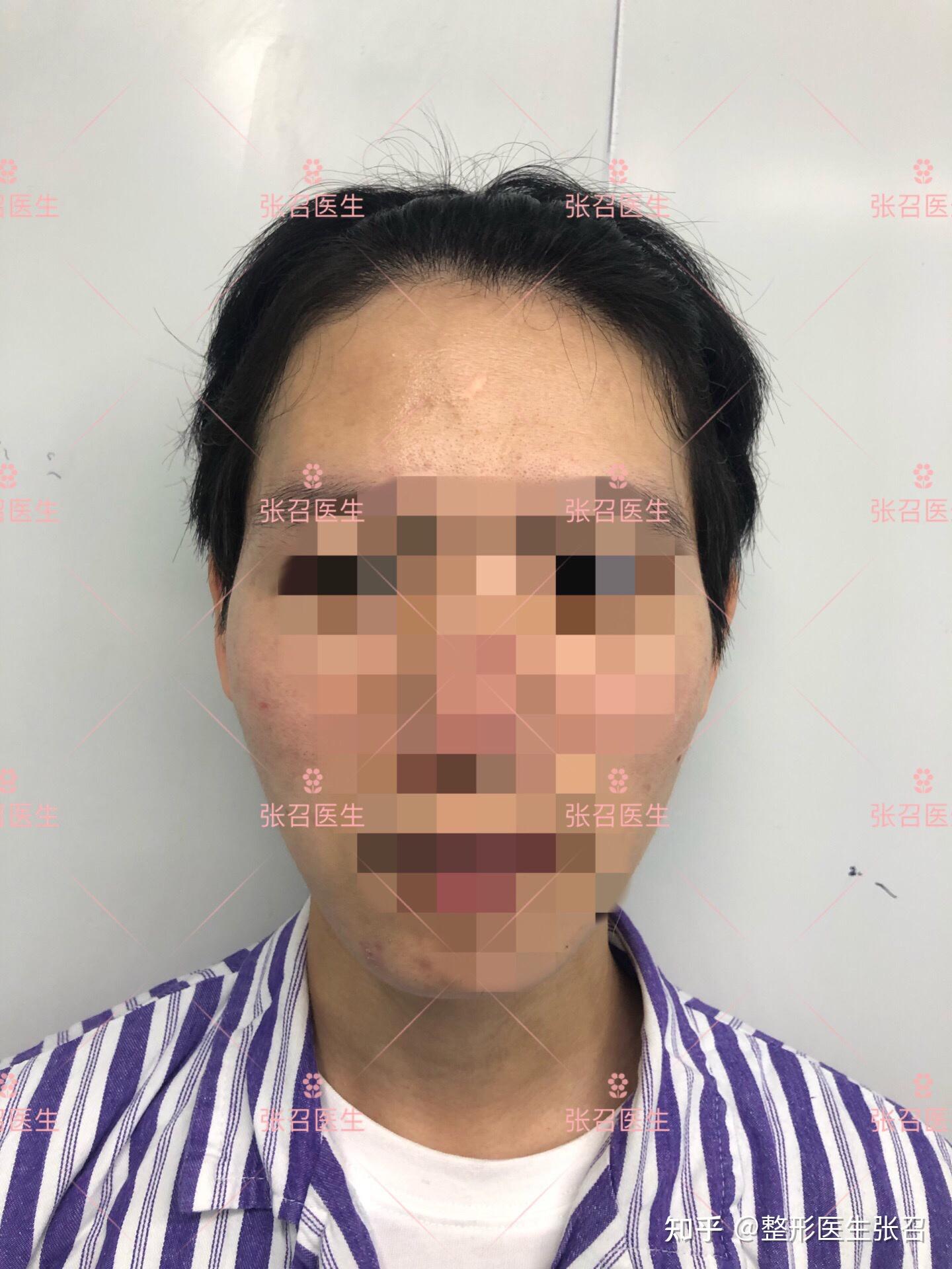 知道额颞角在哪里吗? - 知乎