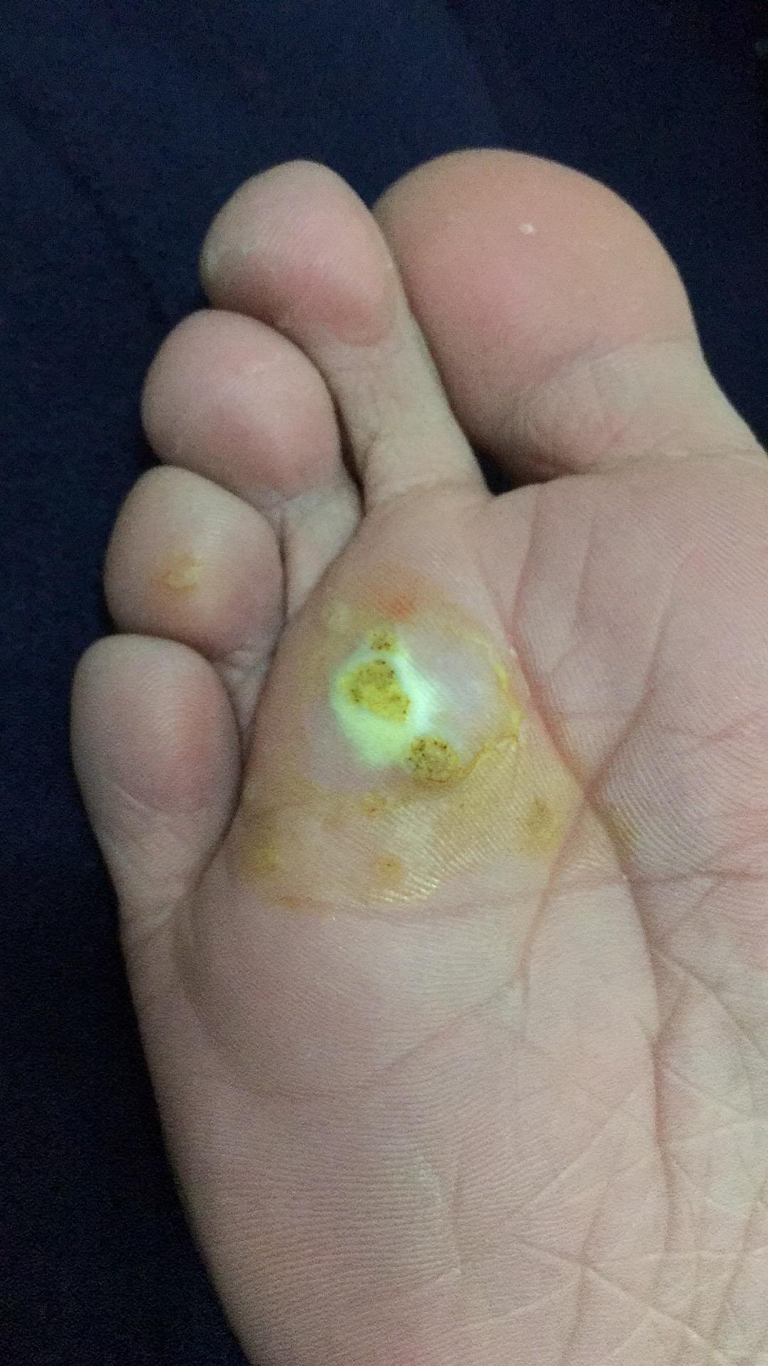 用激光治腳底的蹠疣疼嗎