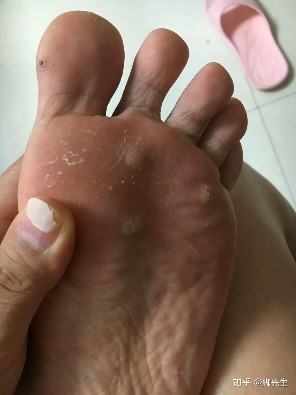 刚长出来的小跖疣怎么治