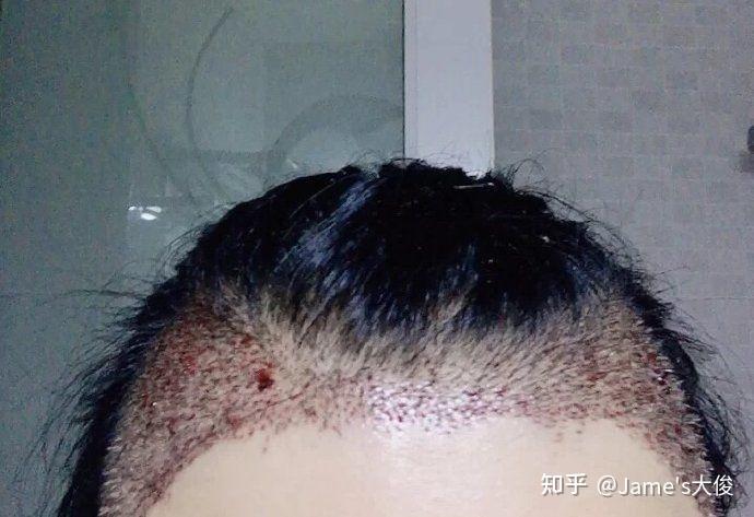 脱发严重 ,有人知道在深圳医院皮肤科检查一次发囊需要多少钱? - 知乎