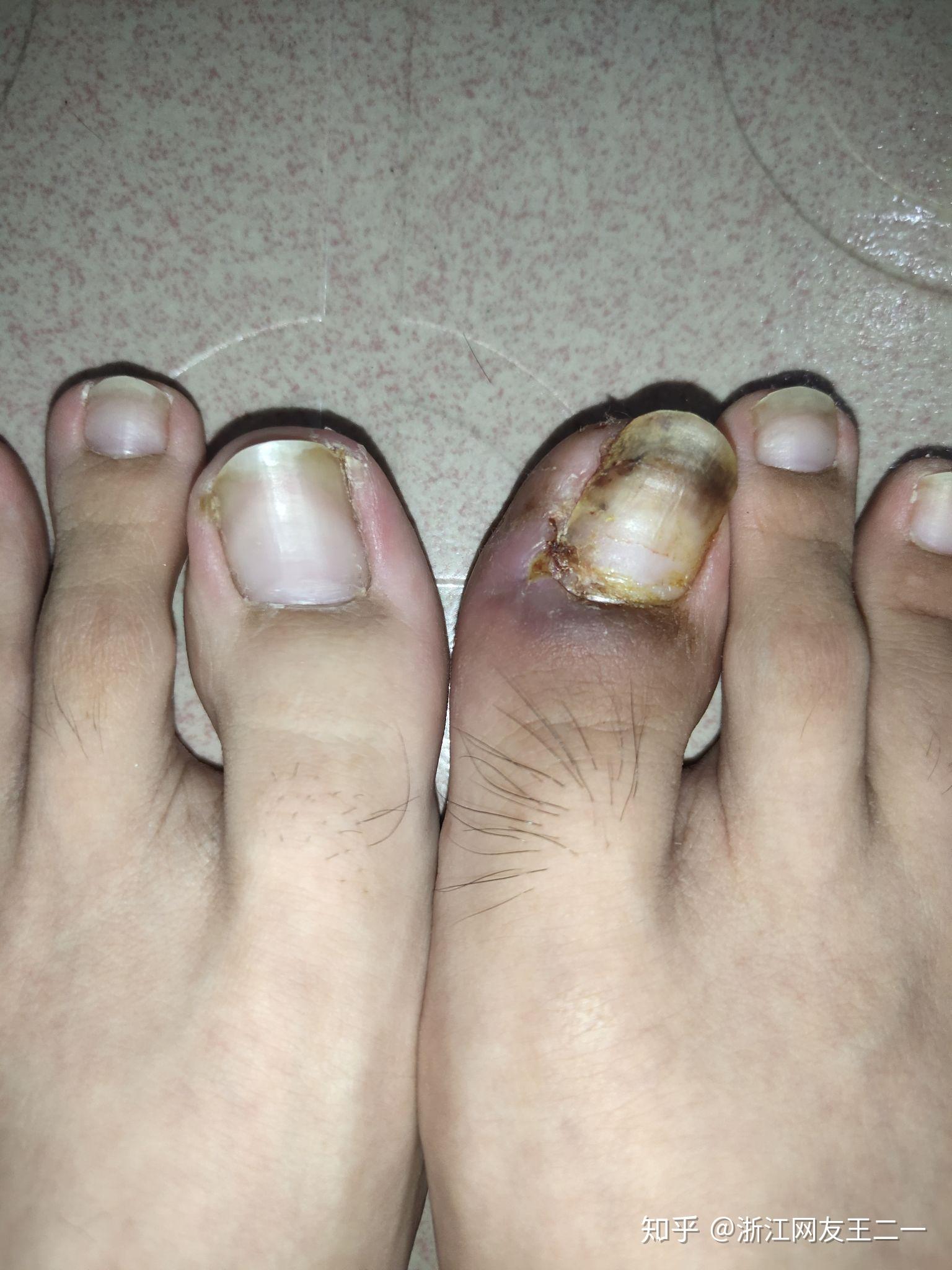 甲沟炎拔甲是怎样的体验? - 知乎